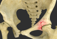 Acetabular Pincer Deformity