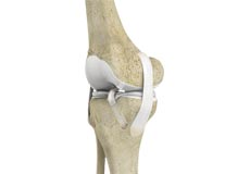 ACL Reconstruction