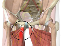 Sports Hernia Repair