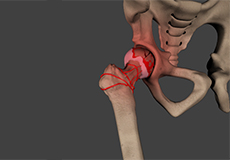 Core Decompression for Avascular Necrosis of the Hip