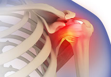Frozen Shoulder/ Adhesive Capsulitis