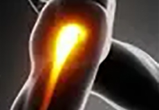 Gluteus maximus transfer
