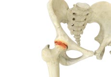 Hip Arthritis