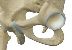 Hip Labral Augmentation