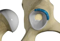 Hip Labral Reconstruction
