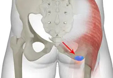 Ischial Bursitis