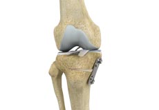 Knee Osteotomy