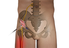 Lateral Femoral Cutaneous Nerve Decompression