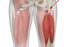 Partial Hamstring Tears