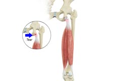 Proximal Hamstring Repair