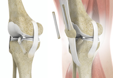 Quadriceps