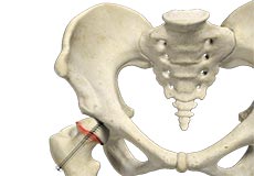 Slipped Capital Femoral Epiphysis (SCFE)