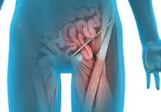 Sports Hernia Repair